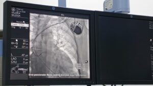 Plan Quirúrgico Nacional garantiza cirugías de alta complejidad con la implantación de 11 marcapasos en el Hospital Coromoto