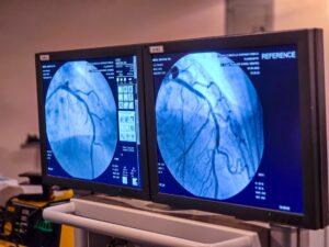Plan Corazón Zuliano avanza en la atención gratuita con 48 pacientes que requieren cateterismos y angioplastias
